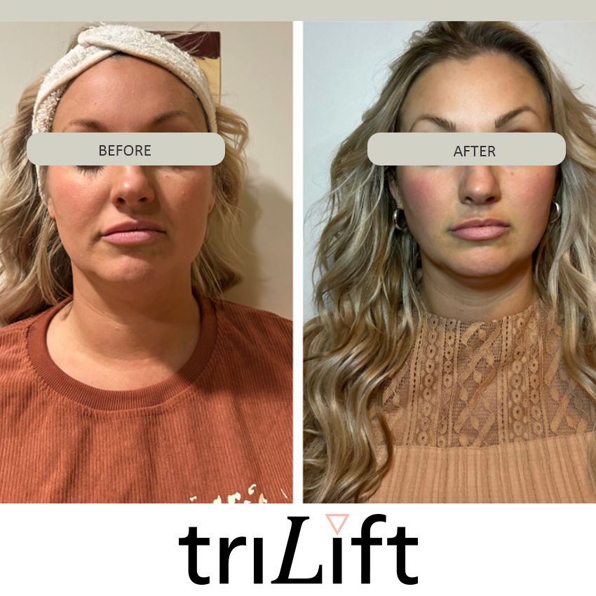 trilift%20marybeth Trilift Face Lift - J.Bentley Hair Studio Day Spa