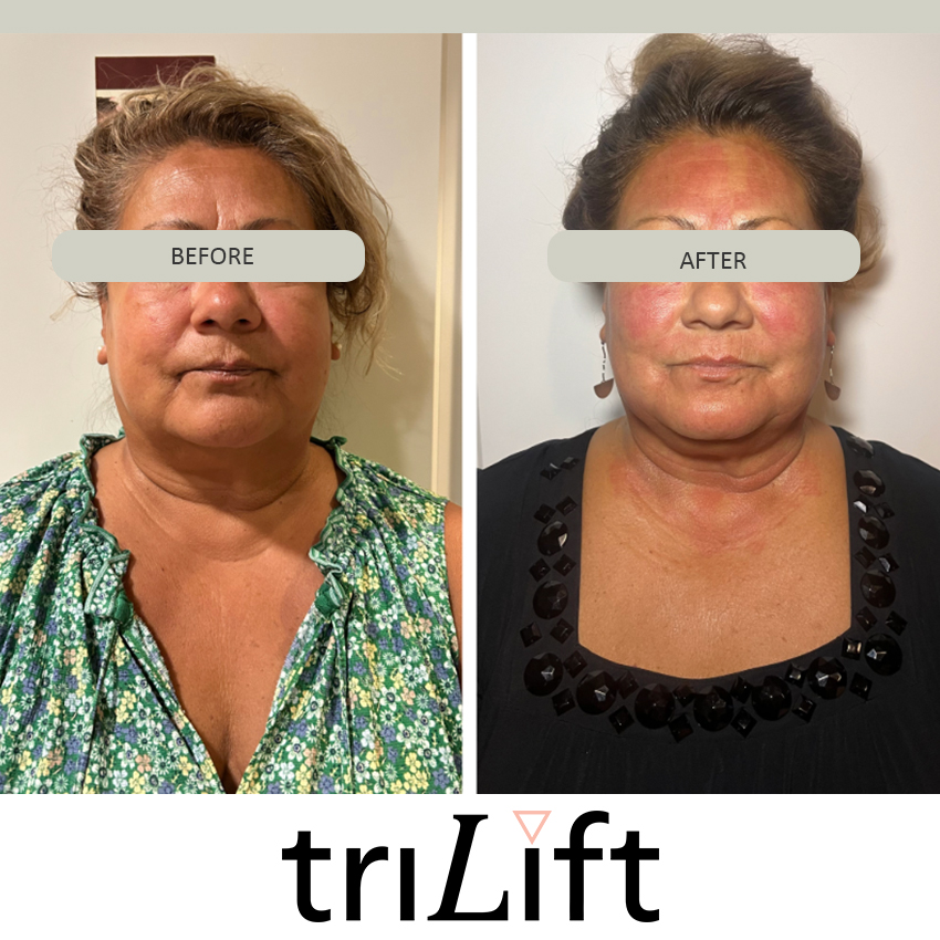 trlifit%20cruz Trilift Face Lift - J.Bentley Hair Studio Day Spa