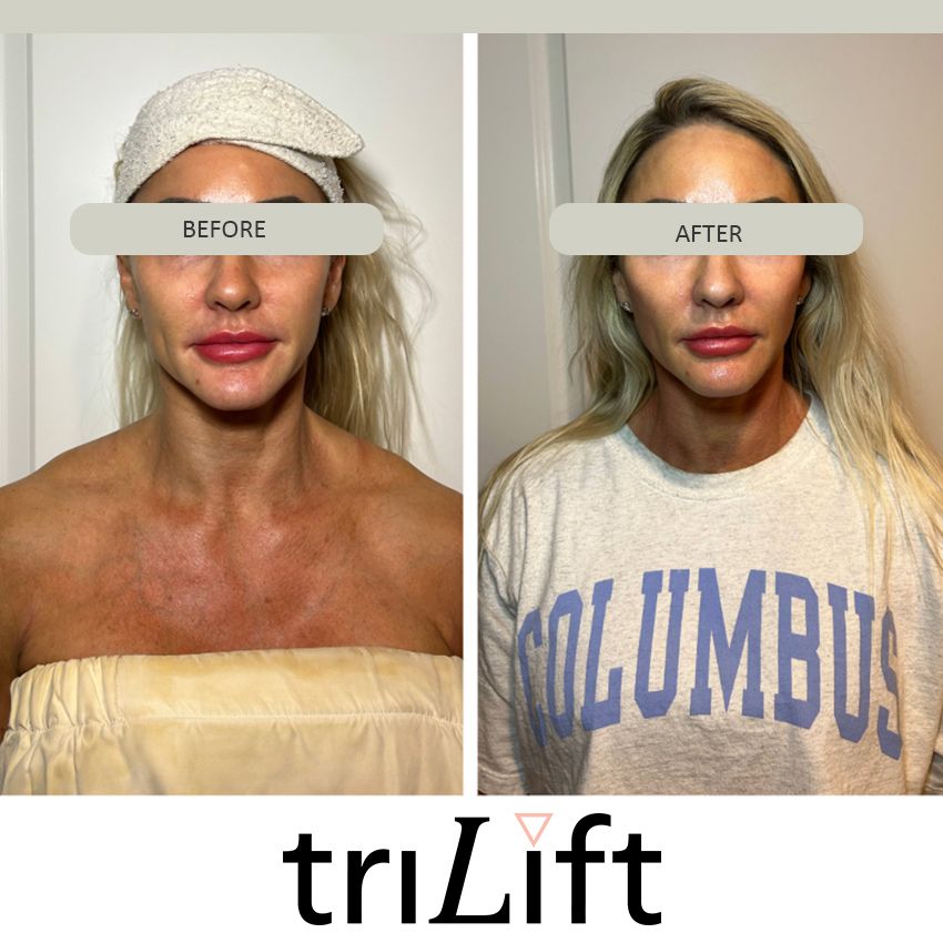 trilift%20ba1-390f91a0 Trilift Face Lift - J.Bentley Hair Studio Day Spa | Powell, OH