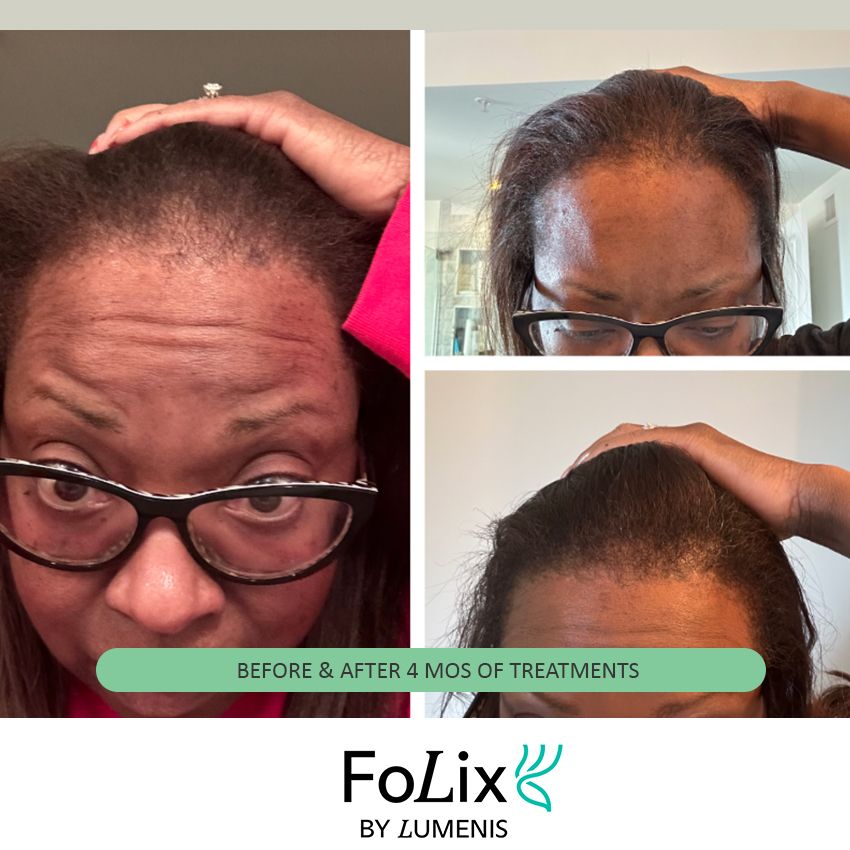 folix%20tyra-3ad0791f Folix Hair Restoration - J.Bentley Hair Studio Day Spa | Powell, OH