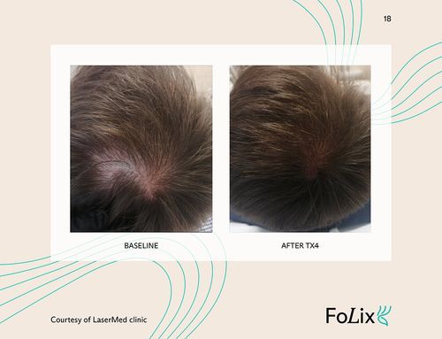 67e5a412fc869dc7afeb9cd0_67da39cbee7c45c9b59f9e41_male%20mild%20ba2-p-500-3bf29caf Folix Hair Restoration - J.Bentley Hair Studio Day Spa | Powell, OH