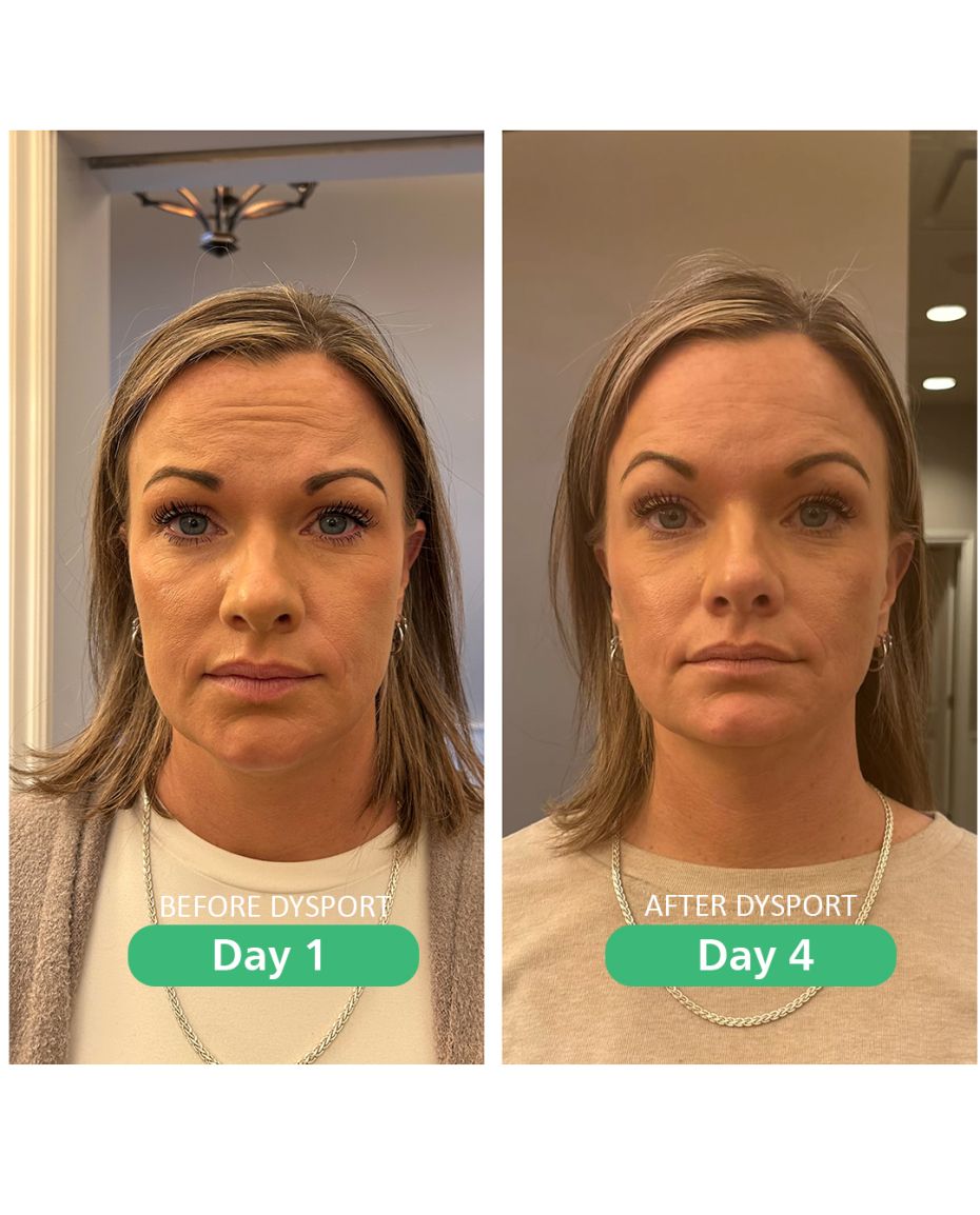 DYSPORT_HERO%20TONYA-4221c702 Current Promotions - J.Bentley Hair Studio Day Spa | Powell, OH