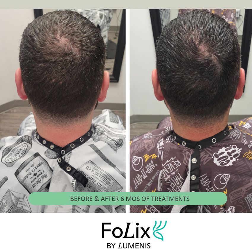 FOLIX%20nick-715c477a Folix Hair Restoration - J.Bentley Hair Studio Day Spa | Powell, OH