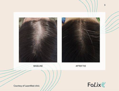 67e5a412df902bb2cff0e124_67da3a2708fd9ca0e56f2562_women%20mild%20ba-p-500-b46fa84b Folix Hair Restoration - J.Bentley Hair Studio Day Spa | Powell, OH