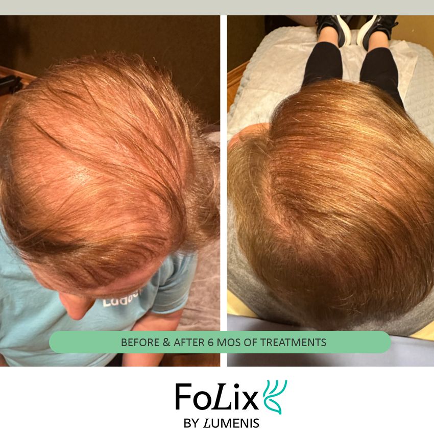 folix%20kathy-b6243d87 Folix Hair Restoration - J.Bentley Hair Studio Day Spa | Powell, OH
