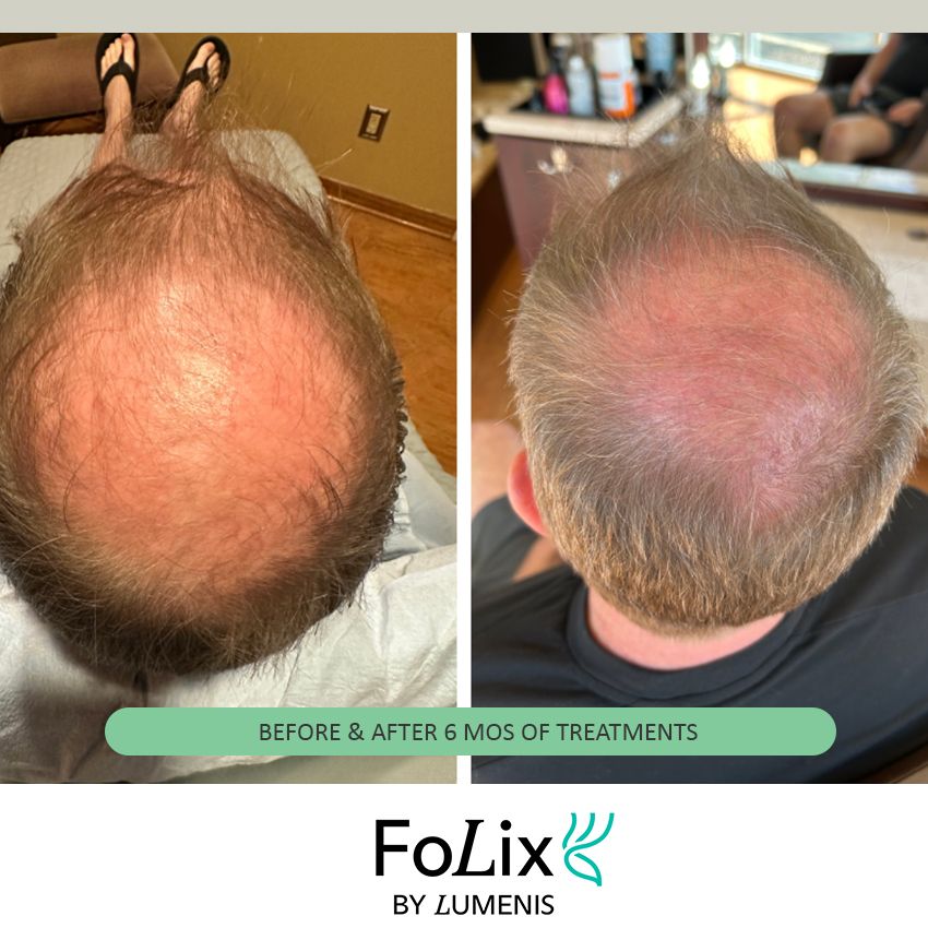 FOLIX%20RON-bfdf114d Folix Hair Restoration - J.Bentley Hair Studio Day Spa | Powell, OH