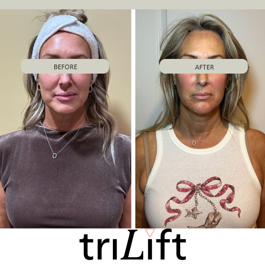 trilift%20michelle-c040d07d Trilift Face Lift - J.Bentley Hair Studio Day Spa | Powell, OH