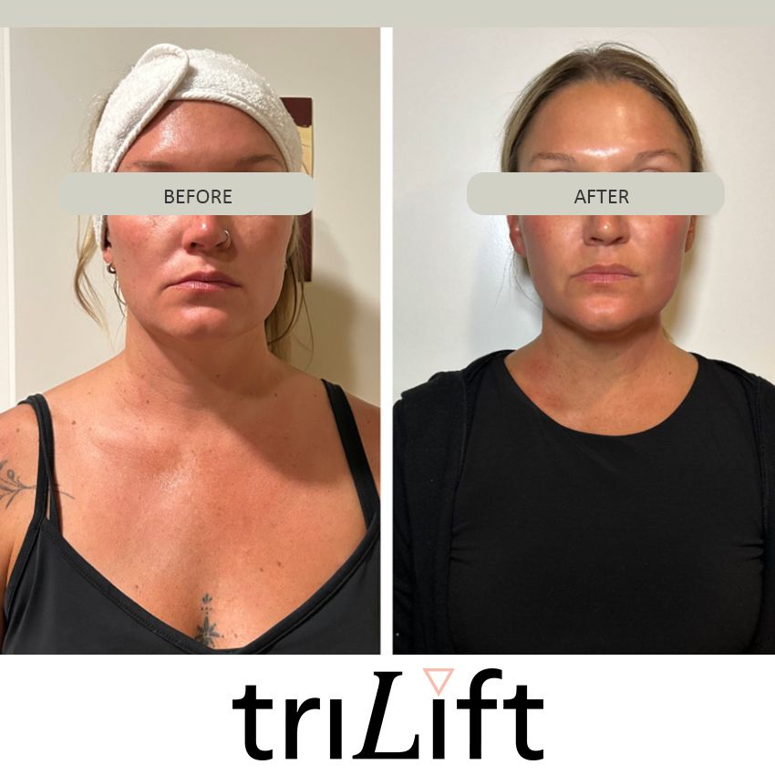 trilift%20kaila-d6cb537d Trilift Face Lift - J.Bentley Hair Studio Day Spa | Powell, OH