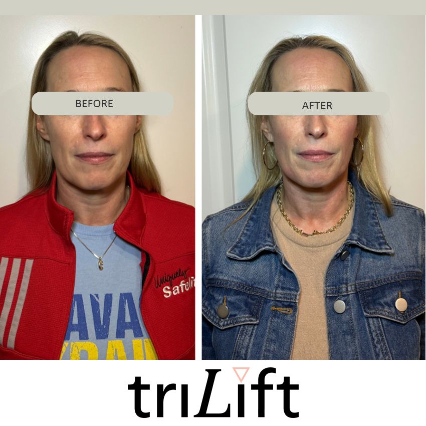 trilift%20christina-dd5ed762 Trilift Face Lift - J.Bentley Hair Studio Day Spa | Powell, OH
